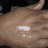 american-vitiligo-treatment-vitiligo-usa
